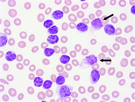 Incidental Finding Of Lymphocytosis In An Asymptomatic Patient The Bmj