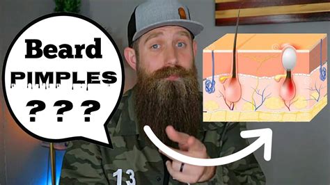 Beard Pimples Cause And Solution Youtube