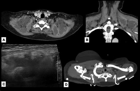 A B Ct Scan Of Neck With Contrast Showing Bilateral Supraclavicular