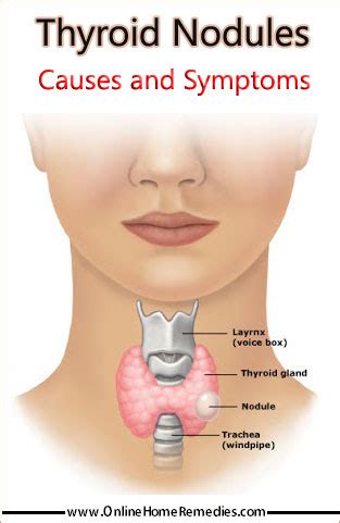However, if you have several nodules, or large nodules, you may be able to see them. Thyroid Nodules Causes, Symptoms and Risk Factors ...