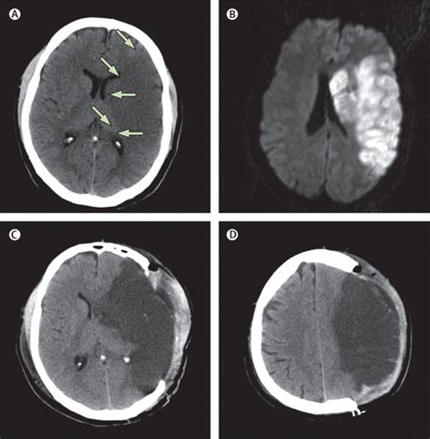 A stroke is an acute neurologic condition resulting from a disruption in cerebral perfusion, either due to ischemia (ischemic strokes) or hemorrhage (hemorrhagic strokes). Malignant middle cerebral artery infarction: clinical ...
