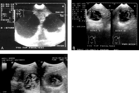 Sonogram Obtained Before Intervention Shows 2 Type 1 Hydatid Cysts Of