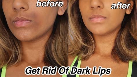 How To Get Rid Of Dark Lips And Pigmentation In 2023 Dark Lips