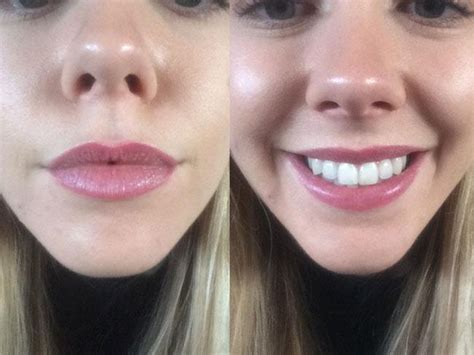 Mothlhtqqjbpqdp Before And After Lip Blush Tattoo Colors