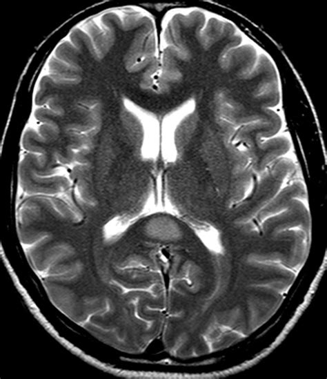 My E Radiology Cases Case 339 40 Year Old Man With Seizure
