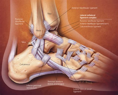 Ankle Sprain Sprain Causes And Treatment Vermont Urgent Care