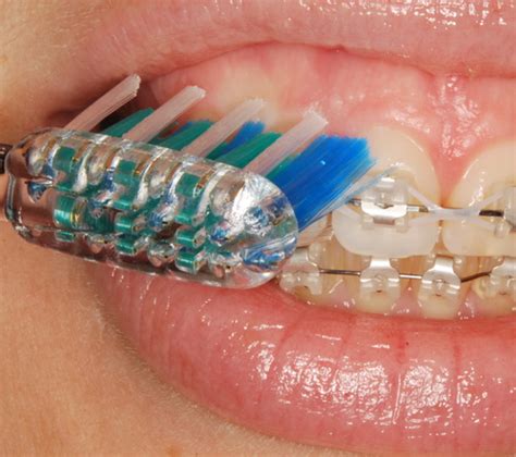 How To Look After Your Braces Platinum Orthodontics