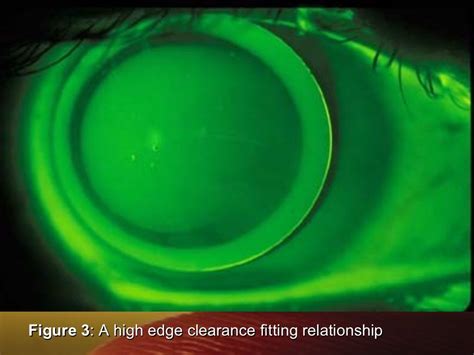 Fitting Rgp Lenses Lenses Bifocal Lenses Soft Lens