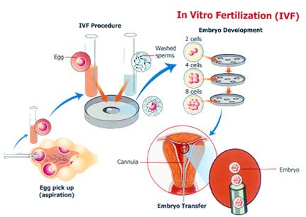 This is an elective procedure designed to result in the. In vitro fertilization: a scientific boon and relief for ...