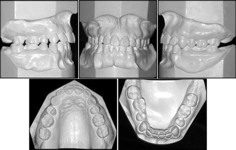 Orthodontic Surgical Retreatment Of Facial Asymmetry With Occlusal Cant