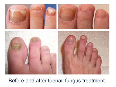 This usually occurs after these organisms come into. Toenail Fungus Treatment | Azul Medspa