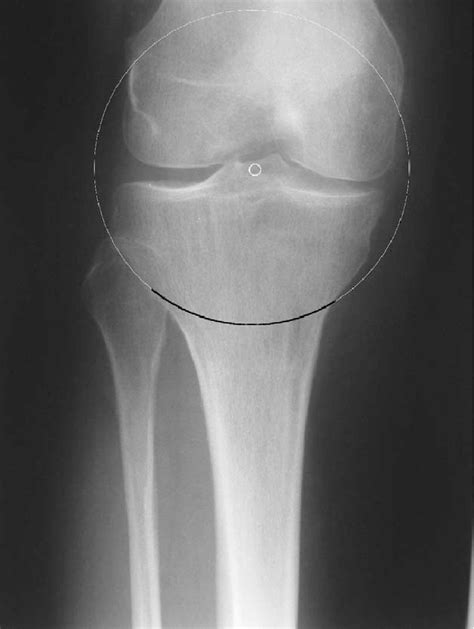 Ap Radiograph Of The Proximal Tibia Showing How A Dome Osteotomy Convex