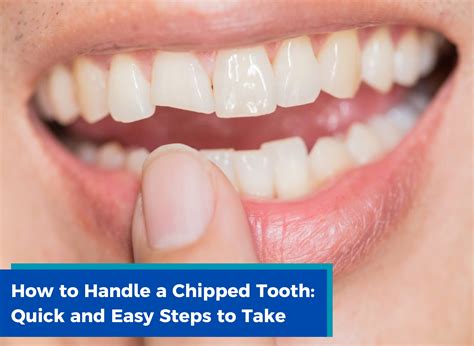 How To Handle A Chipped Tooth Quick And Easy Steps To Take