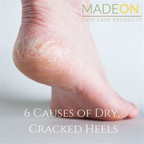 How To Heal Deep Cracked Heels Madeon Skin Care