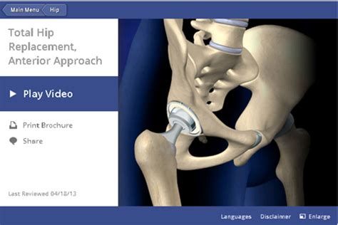 Hip Replacement Approaches