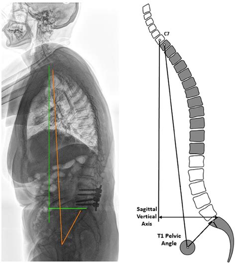 Sagittal Balance From Theory To Clinical Practice In Efort Open