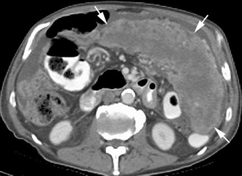 Abdominal Mesothelioma Primary Peritoneal Epithelioid Mesothelioma