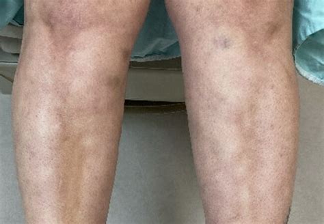 New Onset Eosinophilic Fasciitis After Covid 19 Infection Consult Qd
