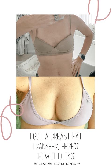 Before And After Breast Fat Transfer Ancestral Nutrition