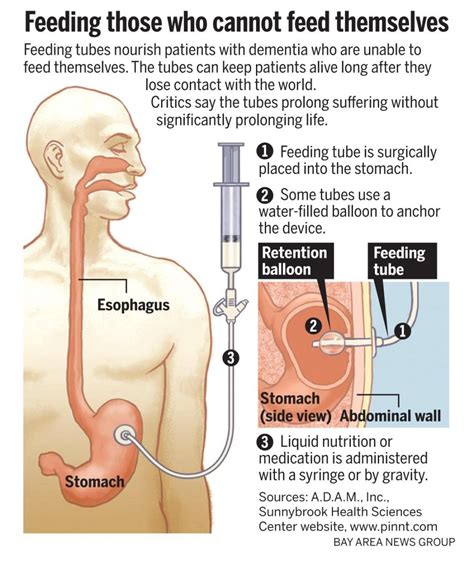 The Cost Of Dying Simple Act Of Feeding Poses Painful Choices The