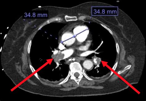 Cureus Massive Pulmonary Embolism In A Recent Intracranial Hemorrhage A Case Report Of