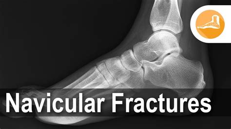 Navicular Fractures With Dr Erik Nilssen Youtube