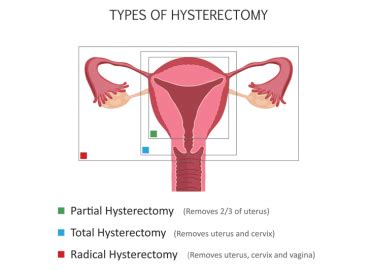 Vaginal Hysterectomy Cpt Code