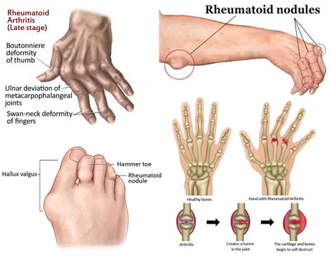 Rheumatoid Arthritis Nodules On Fingers