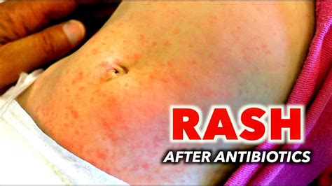 Rash After Antibiotics Is This An Allergic Reaction Dr Youtube