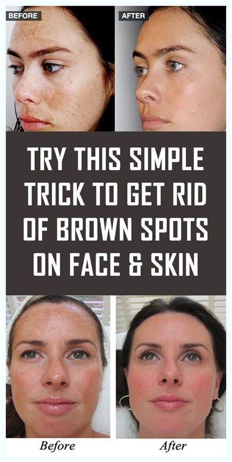 SIMPLE TRICK TO REMOVE BROWN SPOTS FROM YOUR SKIN