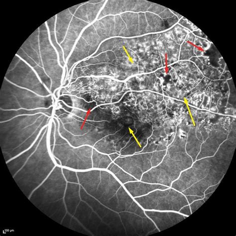 Central Retinal Vein Occlusion Ischaemic In The Right Eye Note The
