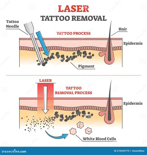 Laser Tattoo Removal Process Labeled Educational Explanation Outline Concept Stock Vector