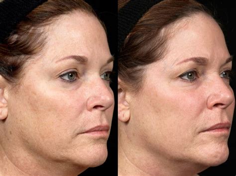 Laser Facial Before And After Emerge Fractional Laser Results