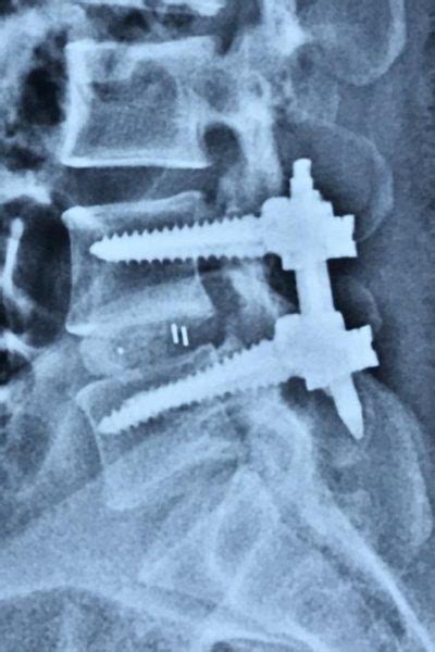 Do You Need Spine Instrumentation Fusion Surgery