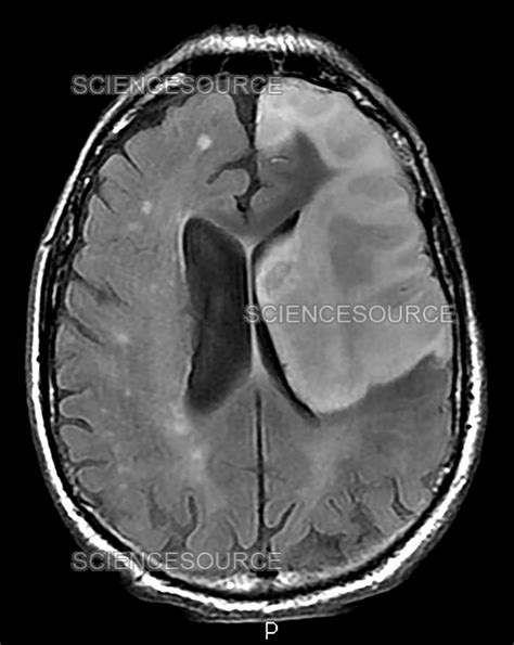 Photograph Hemorrhagic Stroke Mri Science Source Images