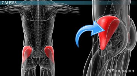 Gluteus Medius Muscle