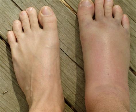 Ankle sprains are common injuries that occur among symptoms of a severe sprain are similar to those of a broken bone and require prompt medical evaluation. Sprained Ankle Pictures