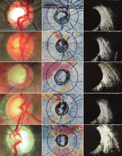 A E Clinically Documented Optic Disc Cupping From 06 To Total