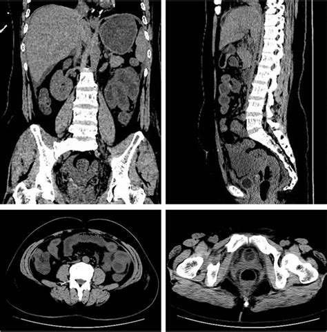 Ct Plain Scan Of The Pelvic And Abdominal Cavity Download Scientific