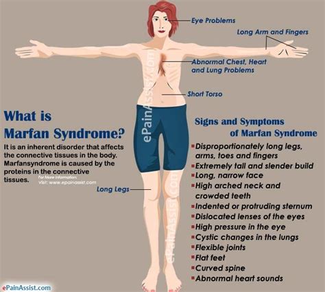 What Is Marfan Syndrome Marfan Syndrome Osteoporosis Causes Syndrome