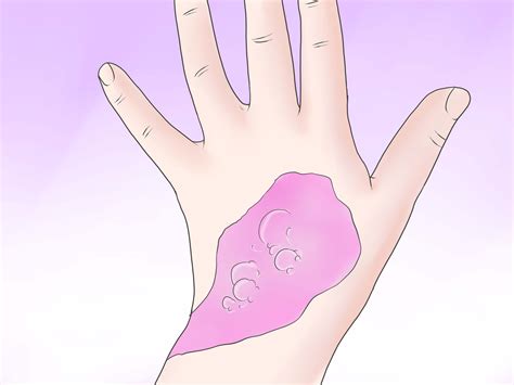 How To Treat A Chemical Burn 6 Steps With Pictures Wikihow