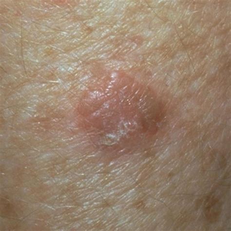 78 Best Squamous Cell Carcinoma Information Images On Pinterest