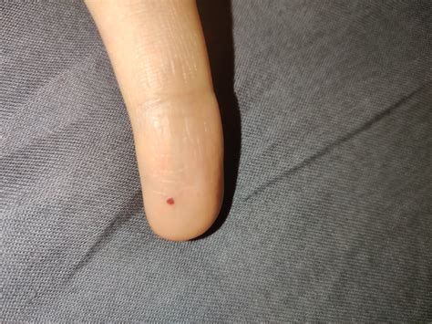 Красное пятнышко на пальце Вопрос дерматологу 03 Онлайн