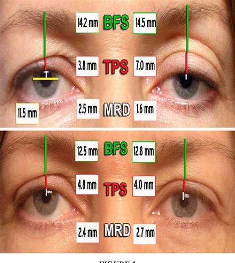Figure 1 From Cosmetic Outcome Of Posterior Approach Ptosis Surgery An