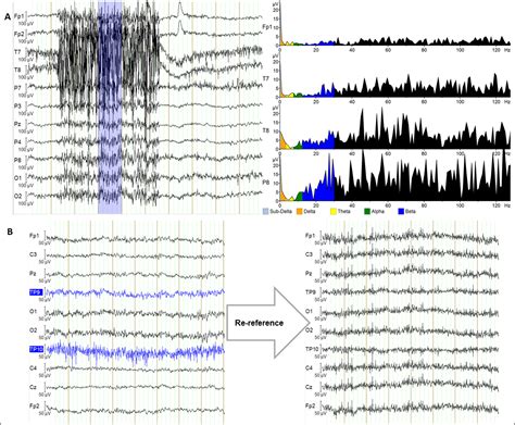 Getting To Know Eeg Artifacts And How To Handle Them In Brainvision Analyzer