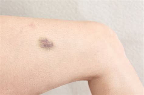 Premium Photo Bruise On A Womans Leg Limb Injury