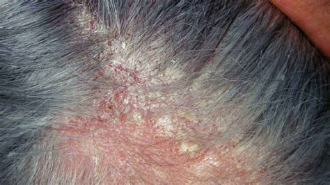 Dermatite Seborroica Come Avere Sollievo E Guarire Con Questi Metodi