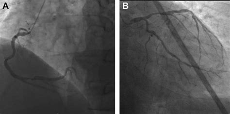 Coronary Artery Bypass Surgery After Transradial Catheterization