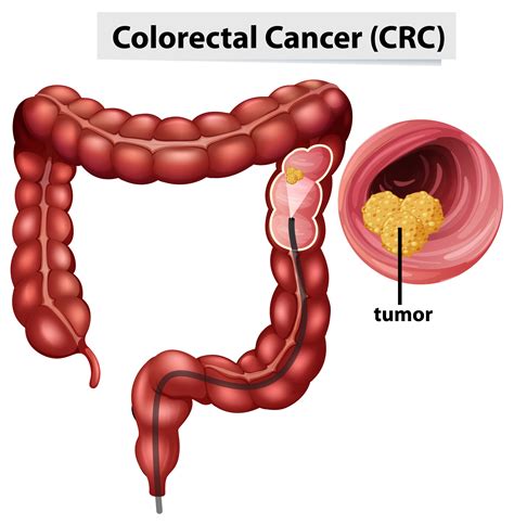 Colon Cancer And Rectal Cancers Dr Ram Chandra Soni