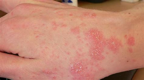 Superdrug Health Clinic Types Of Bacterial Skin Infections